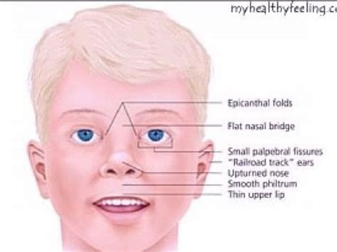 who discovered prader willi syndrome